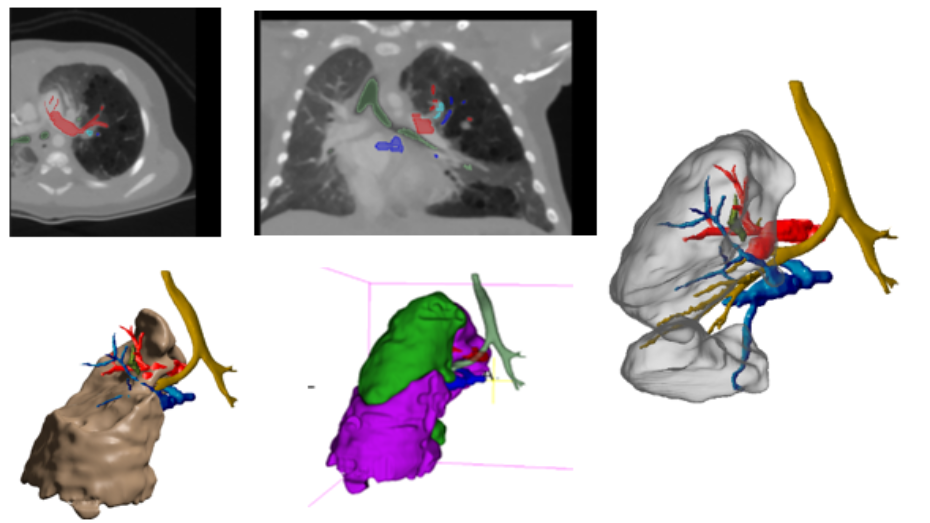 Imagen radiológica de segmentación 3D del pulmón, imagen radiológica de segmentación 3D del sistema interno del pulmón, modelo virtual de la malformación pulmonar