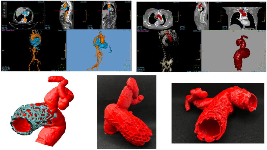 Imagen radiológica prequirúrgica aorta, imagen radiológica prequirúrgica aorta proximal, modelo virtual 3D, biomodelo impreso vista 1, biomodelo impreso vista 2