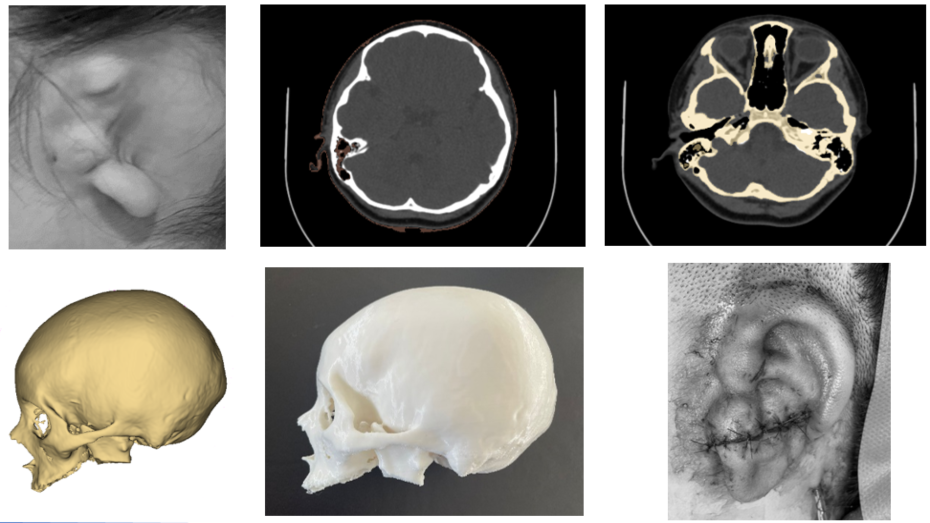 Imagen defecto microtia prequirúrgica, imagen radiología prequirúrgica utilizada para la segmentación, imagen radiología prequirúrgica utilizada para la segmentación, modelo virtual 3D, vista lateral del modelo impreso, imagen cirugía