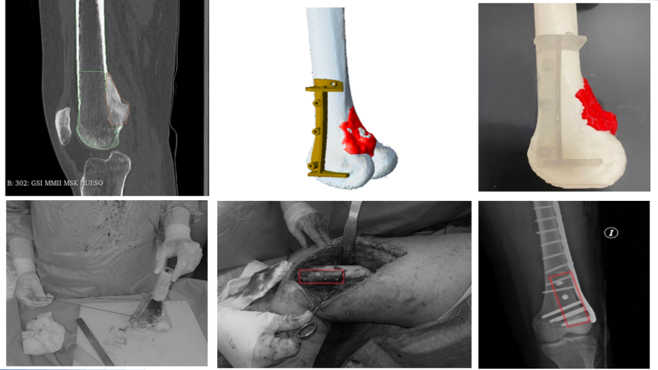 Imagen radiológica prequirúrgica, modelo virtual 3D, modelo y guía impreso 3D, imagen quirúrgica, imagen quirúrgica, imagen postquirúrgica