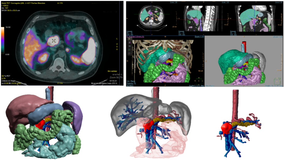 Imagen radiológica prequirúrgica, segmentación imagen radiológica, modelo virtual 3D