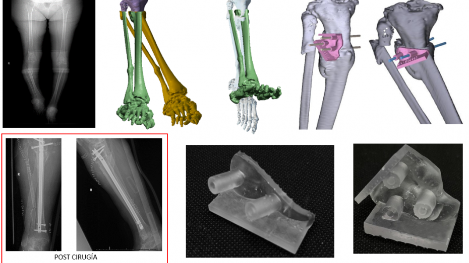 Imagen radiológica prequirúrgica, modelo virtual 3D, guía diseñada, guía impresa