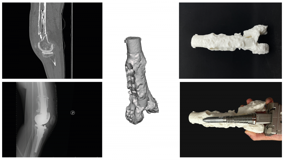 Imagen radiológica prequirúrgica, modelo virtual 3D, biomodelo impreso 3D, imagen radiológica postquirúrgica, planificación quirúrgica