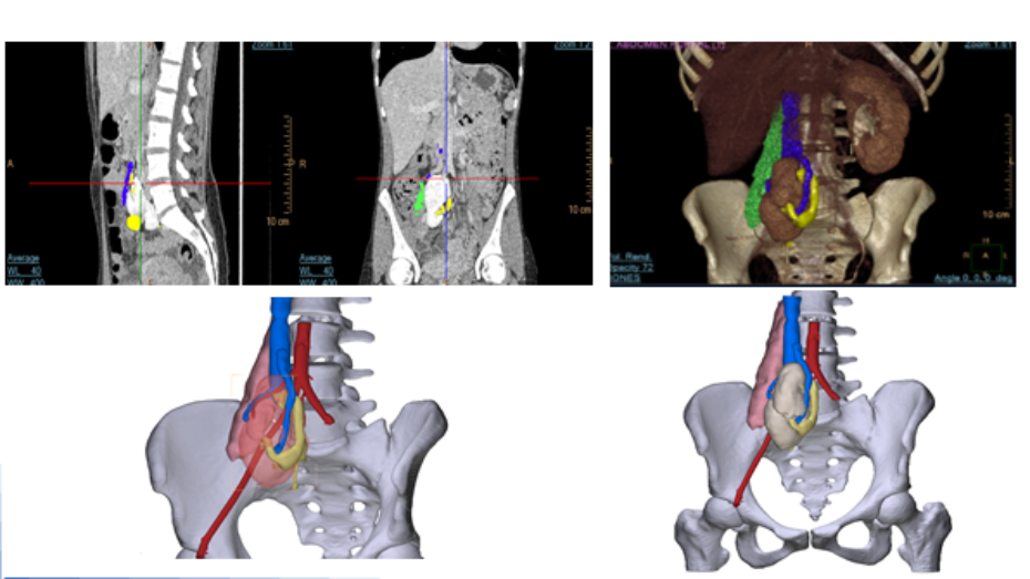 Imagen radiológica prequirúrgica, resultado segmentación, modelo virtual 3D, modelo virtual 3D