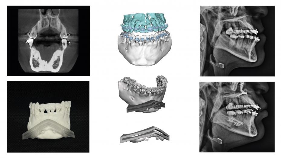Imagen radiológica utilizada para la segmentación, modelo virtual 3D, imagen radiológica prequirúrgica, guía de corte impresa, imagen postquirúrgica