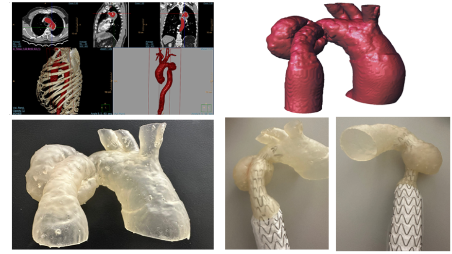 Imagen radiológica prequirúrgica segmentada, modelo virtual 3D, modelo impreso 3D, modelo impreso 3D (test)