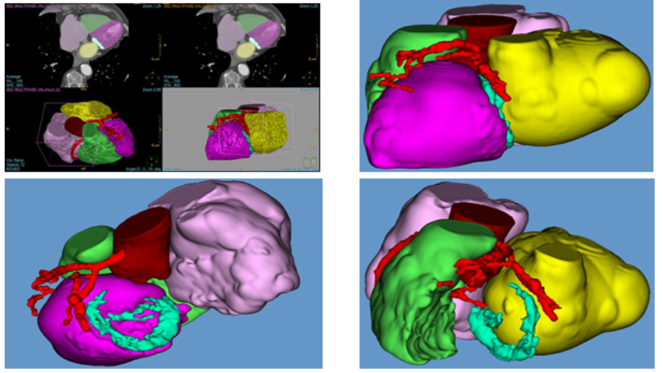 Imagen radiológica prequirúrgica segmentada, modelo virtual 3D, modelo virtual 3D, modelo virtual 3D 