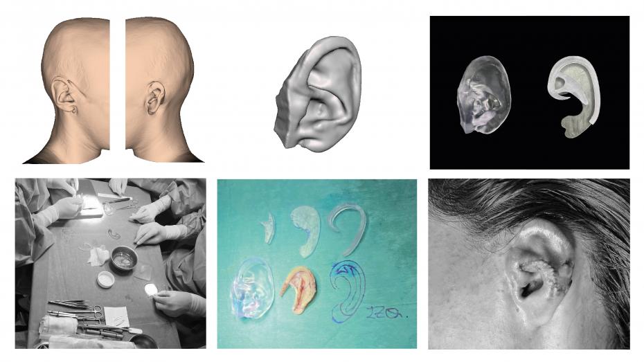 Modelo virtual 3D, modelo virtual de la oreja especular, oreja y guías impresas 3D, imagen quirúrgica