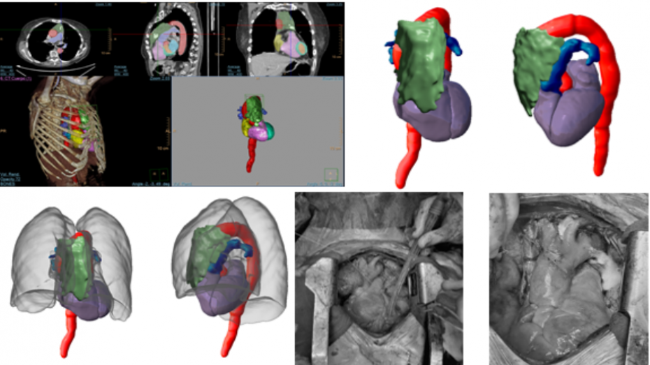 Imagen radiológica prequirúrgica segmentada, modelo virtual 3D, modelo virtual 3D, imagen quirúrgica, imagen quirúrgica