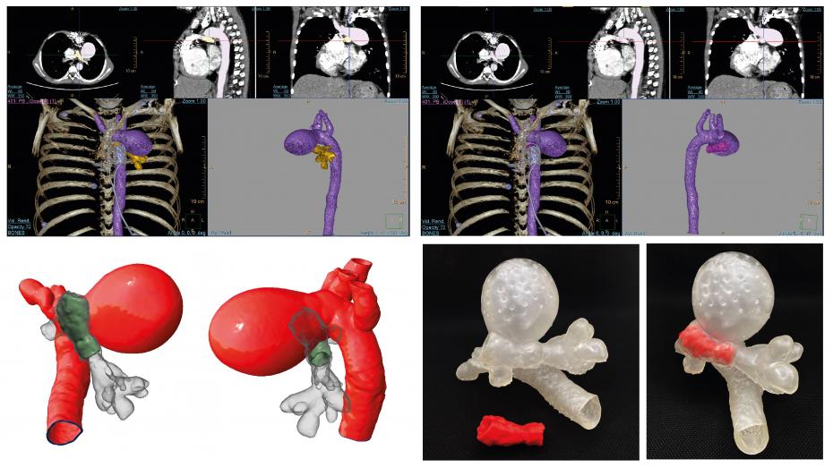 Imagen radiológica prequirúrgica segmentada, imagen radiológica prequirúrgica segmentada, modelo virtual 3D, modelo impreso 3D