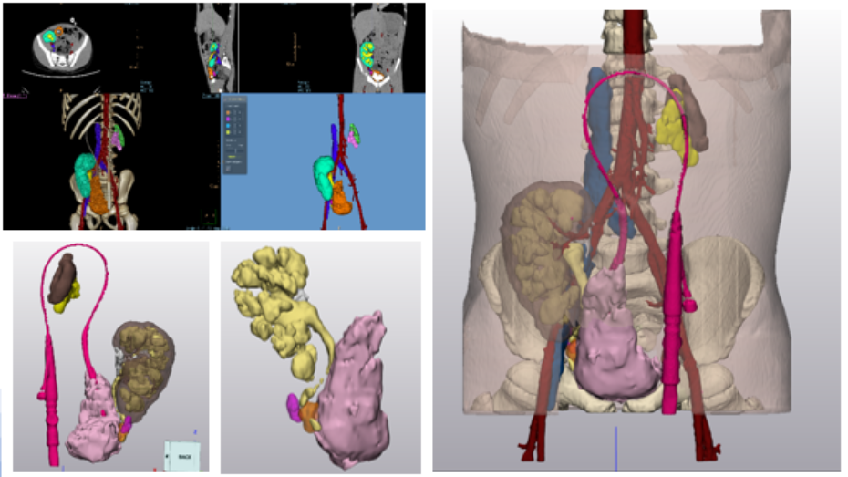 Imagen radiológica prequirúrgica segmentada, modelo virtual 3D, modelo virtual 3D, modelo virtual 3D