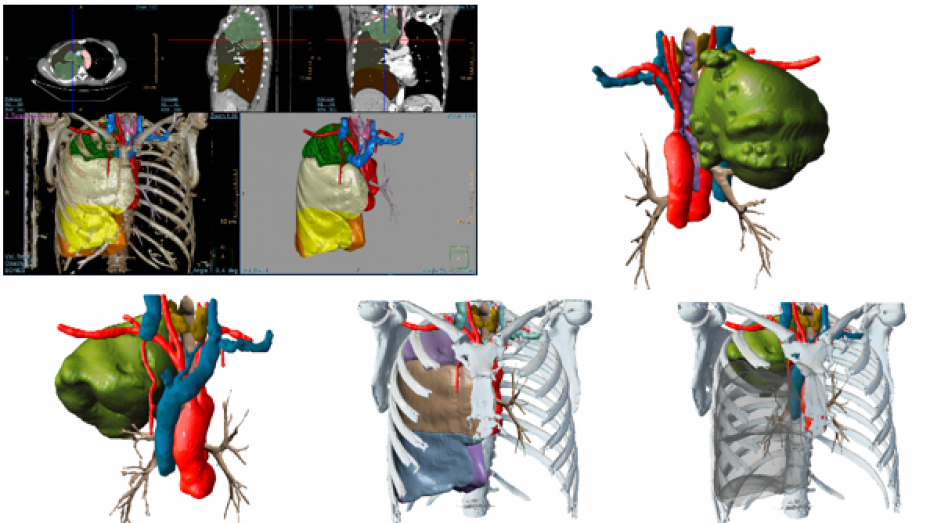 Imagen radiológica prequirúrgica segmentada, modelo virtual 3D, modelo virtual 3D, modelo virtual 3D, modelo virtual 3D