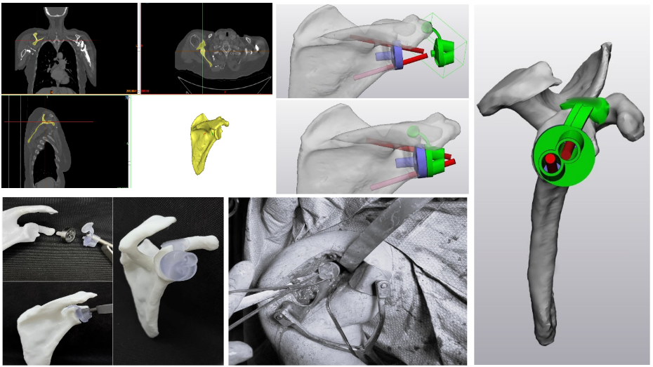 Imagen radiológica prequirúrgica segmentada, modelo virtual 3D, modelo virtual 3D, guía impresa, imagen quirúrgica