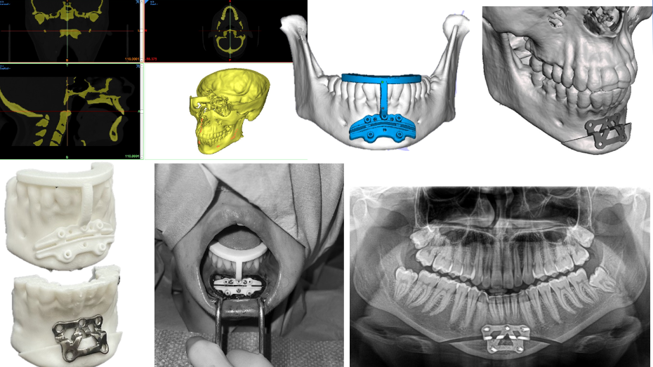 Imagen radiológica prequirúrgica, modelo virtual 3D, imagen quirúrgica, imagen postquirúrgica