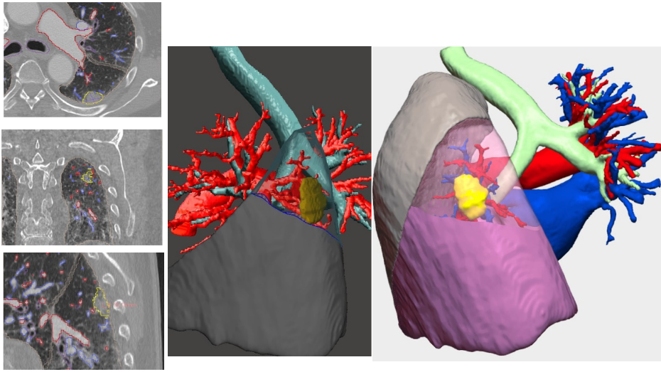 Imagen radiológica prequirúrgica, modelo virtual 3D, modelo virtual 3D. 