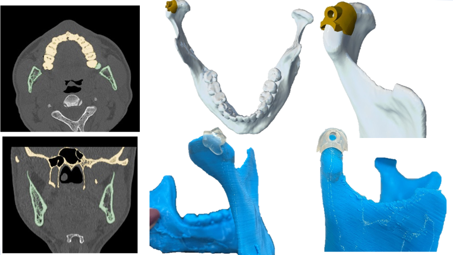 Imagen radiológica prequirúrgica, modelo virtual 3D, modelo y guía impresos