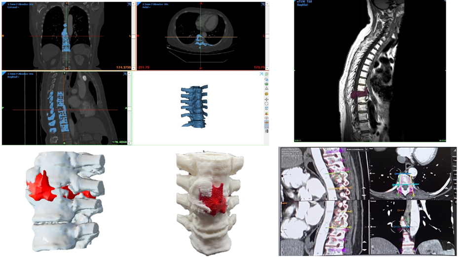 Imagen radiológica prequirúrgica (TC), imagen radiológica prequirúrgica (RM), modelo virtual 3D, modelo impreso 3D, modelo virtual 3D (navegador quirófano)