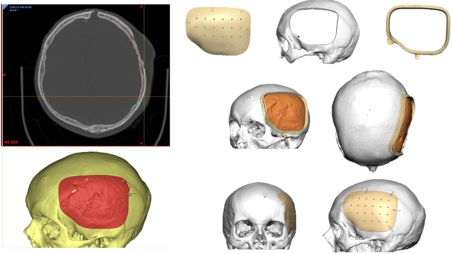Imagen radiológica prequirúrgica, modelo virtual 3D, productos sanitarios a medida, guía quirúrgica, implante a medida