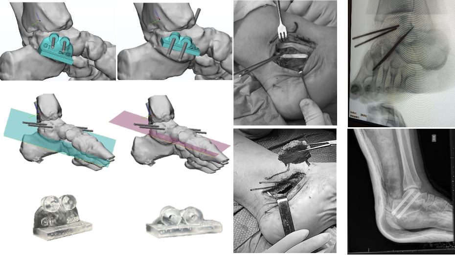 Modelo virtual 3D con las guías de corte, modelo virtual 3D con los planos de corte, guías fabricadas, imágenes quirúrgicas, imagen postquirúrgica