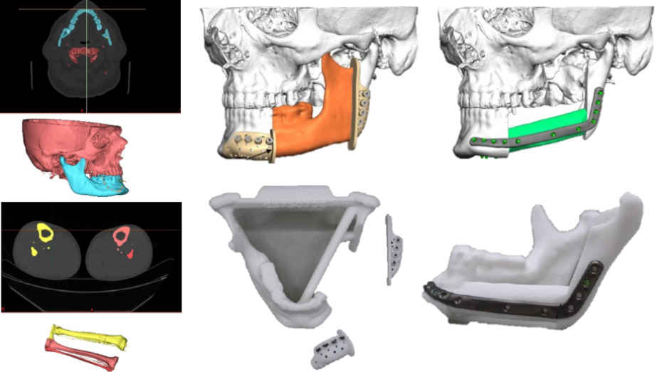 Imagen radiológica prequirúrgica, modelo virtual 3D, guía impresa, implante impreso