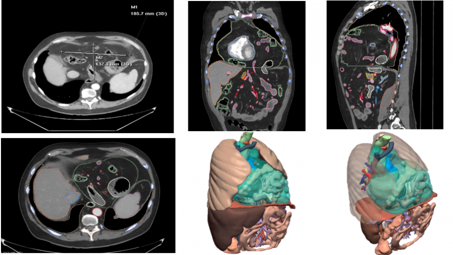 Imagen radiológica prequirúrgica, imagen radiológica prequirúrgica segmentada, modelo virtual 3D