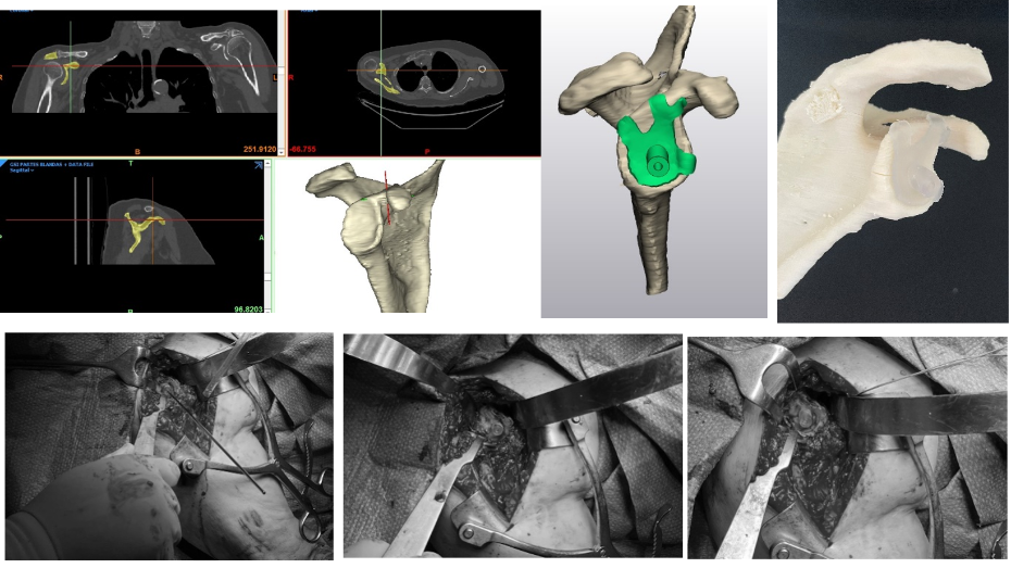 Imagen radiológica prequirúrgica segmentada, modelo virtual 3D, modelo y guía impresa en 3D, imágenes quirúrgicas