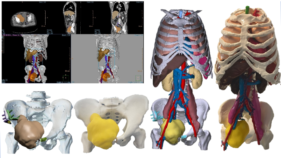 Imagen radiológica prequirúrgica segmentada, modelo virtual 3D, modelo completo impreso a escala real, modelo virtual 3D, modelo de la pelvis impreso a escala real