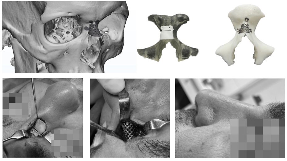 Modelo virtual 3D, guía impresa, implante impreso, imagen quirúrgica con la guía, imagen quirúrgica con el implante, imagen postquirúrgica