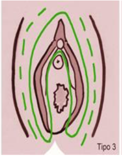 Mutilación genital femenina tipo 3a