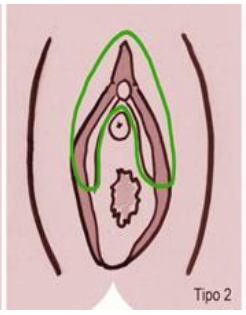 Mutilación genital femenina tipo 2