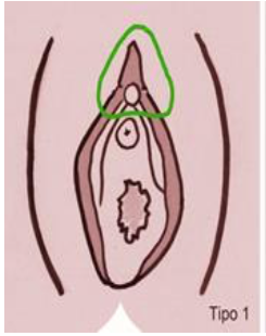 Mutilación genital femenina tipo 1