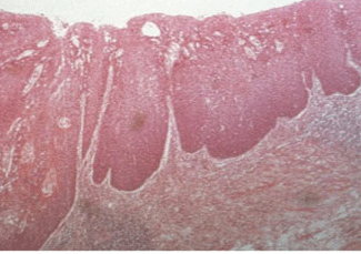 corte histológico de carcinoma