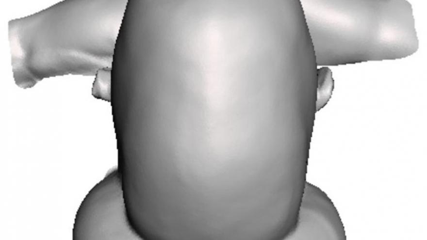 Fantoma 3D de antes de la cirugía