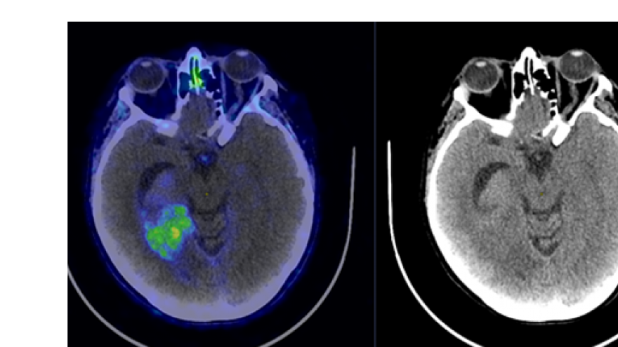 imagen de cerebro con mancha verde