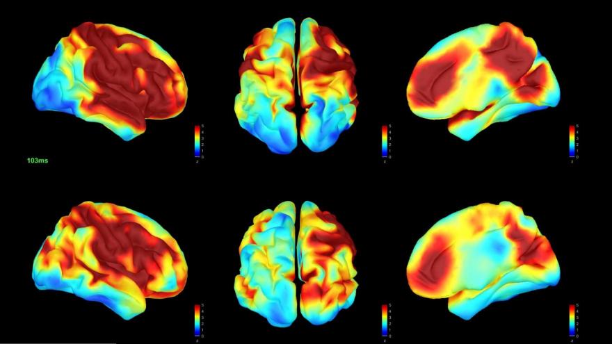 imágenes de cerebros con signos de demencia