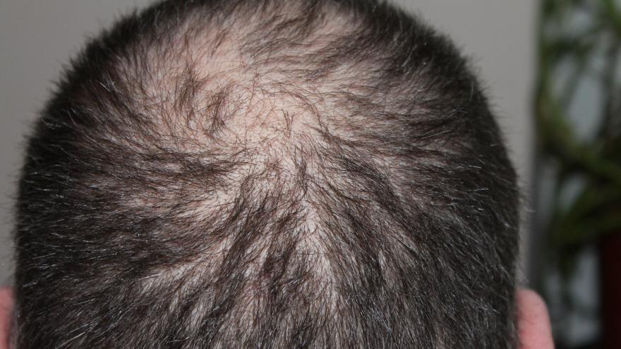 Cabeza con alopecia