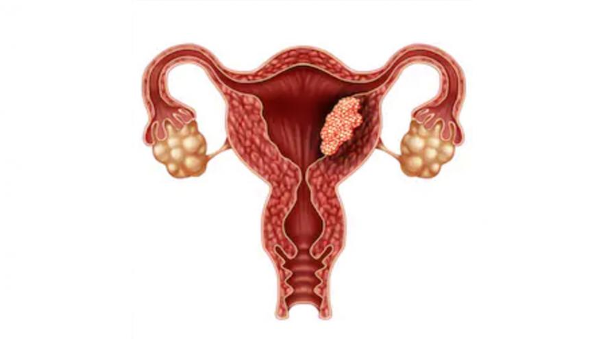 Aparato reproductor femenino con tumores