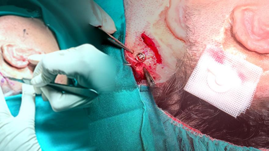 Muestra de todo el proceso hasta la implantación