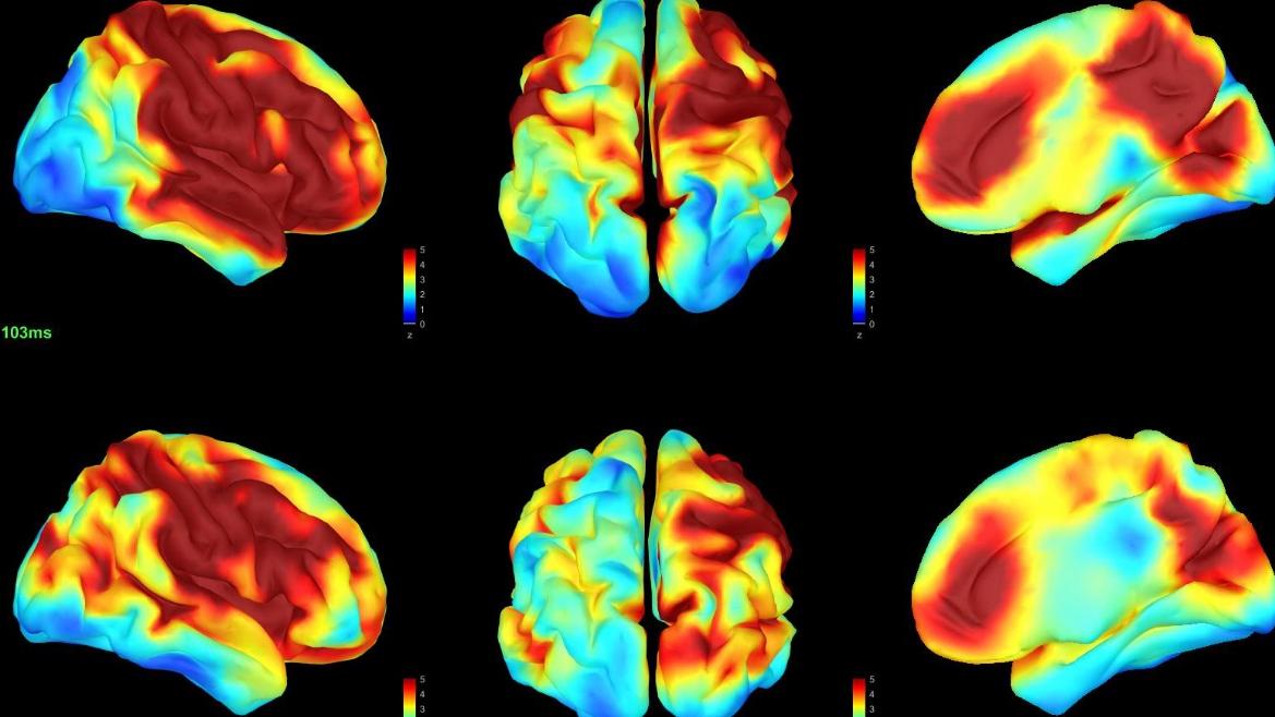 imágenes de cerebros con signos de demencia
